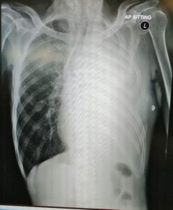 Chest xray with white out of left lung field
