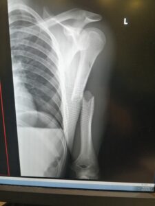 Xray of left humerus fracture